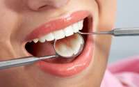 Entenda quando extrair os dentes do siso