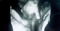 Ultrassom: bebê com poucas chances de sobreviver aparece de mãos dadas com irmã. Veja vídeo
