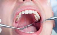 Molar é o dente que mais dá tratamento de canal, diz especialista