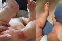 Mãe de bebê que contraiu herpes alerta para que visitas evitem beijos nos pequenos