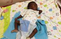 Bebê nasce com 4 pernas e 4 braços em Uganda, na África