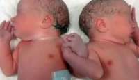 Imagem de gêmeos de mãos dadas após parto faz sucesso