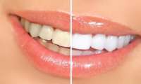 Como evitar o amarelamento dos dentes? Confira!