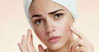 Veja quais as causas da acne na fase adulta?