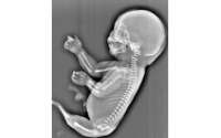 Na China, mulher aborta bebê que nasceria com ‘síndrome da sereia’