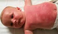 Bebê é internado após usar filtro solar da Peppa Pig