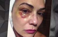 Imagem de hematoma no rosto de Luiza Brunet é revelada
