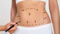 Mulheres que fazem abdominoplastia têm uma perda de peso durável, afirma estudo