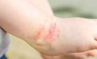 Dermatite atópica: saiba evitar fatores que desencadeiam as crises