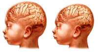 Casos de microcefalia remetem ao trauma da síndrome da talidomida nos anos 60