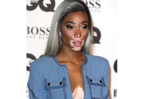 Corredor da F1 está namorando modelo famosa por vitiligo