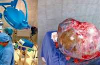 Mulher faz cirurgia para retirar tumor de 60 kg no México
