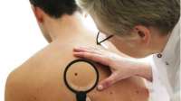 Mais de 11 sinais no braço indica risco de melanoma. Confira!