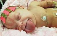 Bebê que nasceu com língua gigante passa por cirurgia