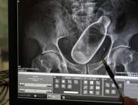 Garrafa no ânus de idoso aparece em raio-X e choca médicos
