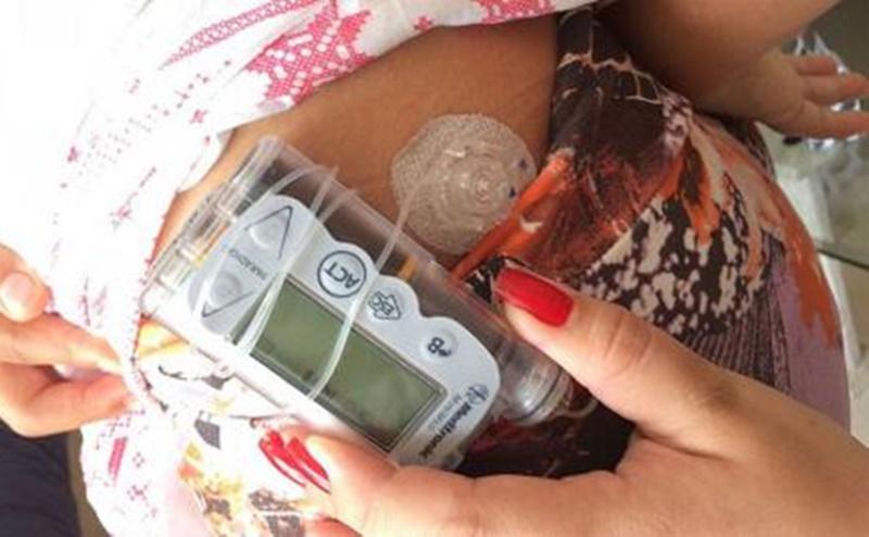 Estudante é impedida de fazer Enem por uso de bomba de insulina