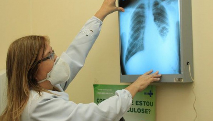 Casos de tuberculose sobem no Paraná e acendem o alerta