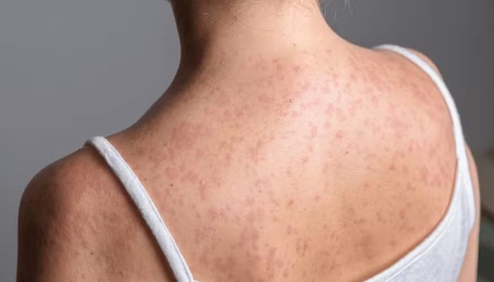 Foto: Getty Images Sarampo não é coisa do passado: entenda os sintomas, riscos e como se proteger