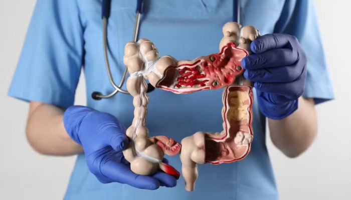 Por que o câncer de intestino está aumentando entre os jovens?