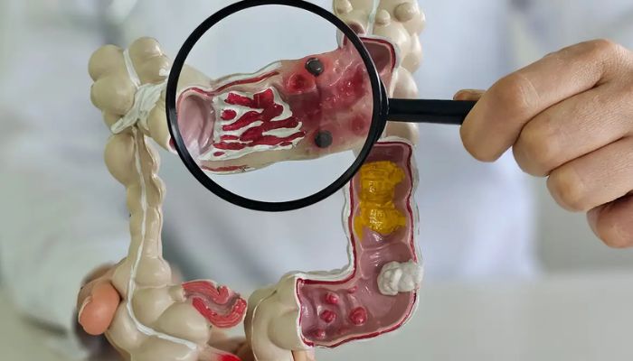 Em 13 anos, doença inflamatória intestinal cresce 5 vezes no Brasil
