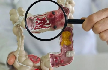 Em 13 anos, doença inflamatória intestinal cresce 5 vezes no Brasil
