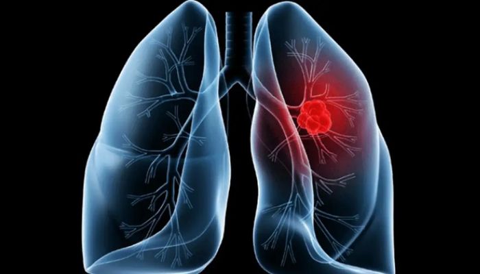 Saiba o que é adenocarcinoma pulmonar, câncer que atinge o papa