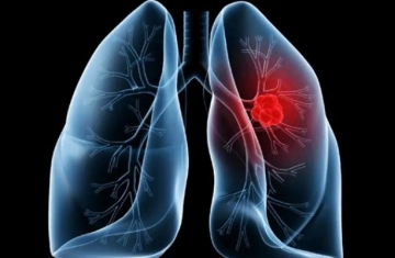 Saiba o que é adenocarcinoma pulmonar, câncer que atinge o papa