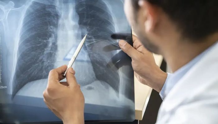 Anvisa aprova novo medicamento para câncer de pulmão avançado