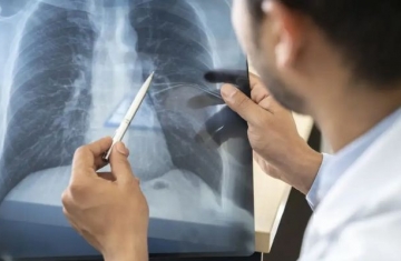 Anvisa aprova novo medicamento para câncer de pulmão avançado
